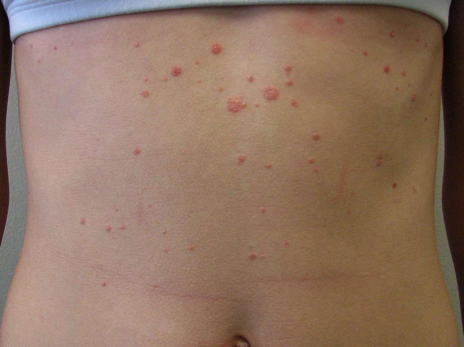 psoriasis body